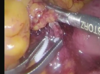 Laparoscopic Anterior Resection in a Patient with Situs Inversus