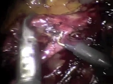 Laparoscopic Apical Lymph Node Dissection of the Inferior Mesenteric Artery (ALMA) Laparoscopic Apical Lymph Node Dissection of the Inferior Mesenteric Artery (ALMA)