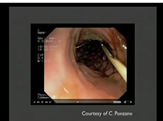 Laparoscopic Approach for Obstructing Colorectal Cancer: Nicolas Demartines, M.D. Laparoscopic Approach for Obstructing Colorectal Cancer: Nicolas Demartines, M.D.