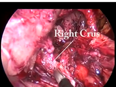 Laparoscopic Approach To Gastric Outlet Obstruction Secondary To A Re-Recurrent Para-Esophageal Hern Laparoscopic Approach To Gastric Outlet Obstruction Secondary To A Re-Recurrent Para-Esophageal Hern