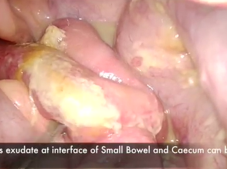 Laparoscopic Caecectomy For Caecal Perforation