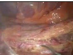 Laparoscopic Colorectal Surgery: Vascular Approach Laparoscopic Colorectal Surgery: Vascular Approach