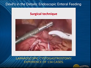 LAPAROSCOPIC CYSTOGASTROSTOMY: EXPERIENCE OF 134 CASES