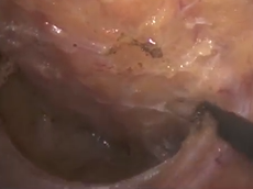 Laparoscopic En Bloc Total Mesorectal Excision Post Chemoradiotherapy