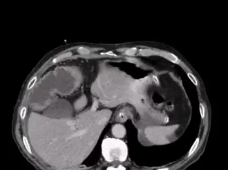 Laparoscopic Extended Right Colectomy with Intracorporeal Anastomosis for Obstructing Colon Cancer