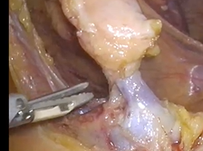 Laparoscopic extended right hemicolectomy for hepatic flexure cancer: primary vascular approach. Laparoscopic extended right hemicolectomy for hepatic flexure cancer: primary vascular approach.