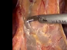 Laparoscopic Extralevator Abdominoperineal Excision for Low Rectal Cancer