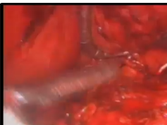 Laparoscopic Heller Myotomy Post Gastric Bypass
