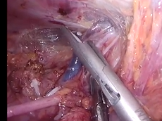 Laparoscopic Left Lateral Pelvic Lymph Node Dissection