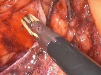 Laparoscopic low anterior resection in an obese male patient with a narrow pelvis Laparoscopic low anterior resection in an obese male patient with a narrow pelvis