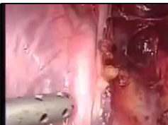 Laparoscopic Low Anterior Resection (TME) for Carcinoma of the Recto-Sigmoid Colon Laparoscopic Low Anterior Resection (TME) for Carcinoma of the Recto-Sigmoid Colon