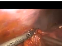 Laparoscopic Management Of Cholecystocolonic Fistula