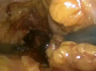 LAPAROSCOPIC MANAGEMENT OF INTRAOPERATIVE ILIAC VEIN INJURY