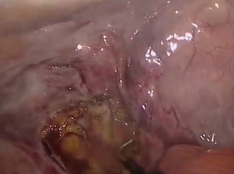 Laparoscopic Management of Retroperitoneal Colonic Perforation From an Ingested Foreign Body Laparoscopic Management of Retroperitoneal Colonic Perforation From an Ingested Foreign Body
