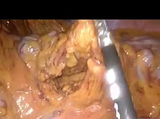 Laparoscopic Marginal Artery Injury at Splenic Flexure Mobilisation Solved by Retroileal Tunnel Laparoscopic Marginal Artery Injury at Splenic Flexure Mobilisation Solved by Retroileal Tunnel