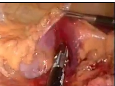 Laparoscopic No-touch Resection of a T4 Colon Cancer Laparoscopic No-touch Resection of a T4 Colon Cancer