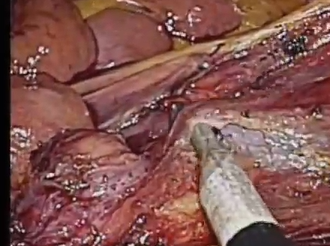 Laparoscopic Paraaortic Lymphadenectomy in a Patient with Nutcracker Syndrome for Rectal Cancer Laparoscopic Paraaortic Lymphadenectomy in a Patient with Nutcracker Syndrome for Rectal Cancer