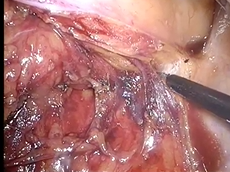 Laparoscopic Pelvic Sidewall Resection: Surgical Anatomy