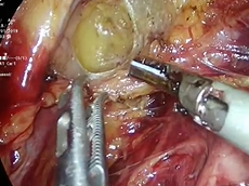 Laparoscopic Posterior Exenteration for Rectal Cancer with Incisional Hernia Repair Laparoscopic Posterior Exenteration for Rectal Cancer with Incisional Hernia Repair