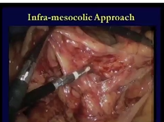 Laparoscopic Pouches - Addressing Inadequate Length: John H. Marks, M.D. Laparoscopic Pouches - Addressing Inadequate Length: John H. Marks, M.D.