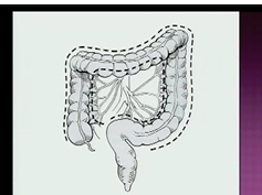 Laparoscopic Pouches in the Pediatric Patient: Keith E. Georgeson, M.D. Laparoscopic Pouches in the Pediatric Patient: Keith E. Georgeson, M.D.