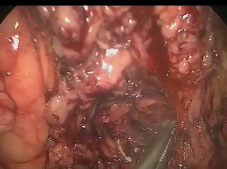 Laparoscopic proctocolectomy and extra-sphincteric dissection for cancer of the anorectal junction Laparoscopic proctocolectomy and extra-sphincteric dissection for cancer of the anorectal junction