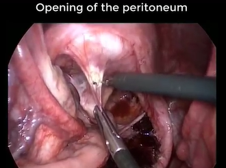 Laparoscopic Re-do Rectopexies