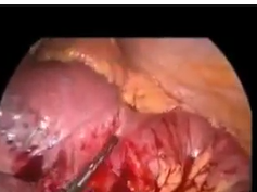 Laparoscopic Removal Of Bezoars In The Jejunojejunal Anastomosis In A Gastric Bypass Patient Present Laparoscopic Removal Of Bezoars In The Jejunojejunal Anastomosis In A Gastric Bypass Patient Present