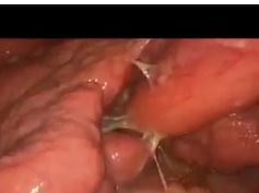 Laparoscopic Repair Of A Perforated Duodenal Ulcer In A Childs Class C Cirrhotic Patient Laparoscopic Repair Of A Perforated Duodenal Ulcer In A Childs Class C Cirrhotic Patient