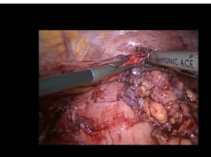 Laparoscopic Repair Of Incarcerated Iatrogenic Diaphragmatic Hernia