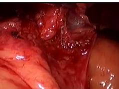 Laparoscopic Repair Of Recurrent Esophageal Perforation Secondary To Peptic Stricture Laparoscopic Repair Of Recurrent Esophageal Perforation Secondary To Peptic Stricture