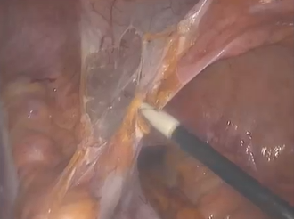 Laparoscopic resection for T4 Rectal Cancer with Local Invasion of the Bladder Laparoscopic resection for T4 Rectal Cancer with Local Invasion of the Bladder