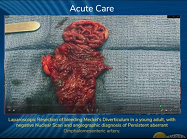 Laparoscopic Resection of bleeding Meckel's Diverticulum in a young adult