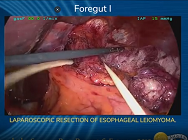 LAPAROSCOPIC RESECTION OF ESOPHAGEAL LEIOMYOMA