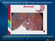 Laparoscopic Revision and Reversal for Historic Gastroplasty