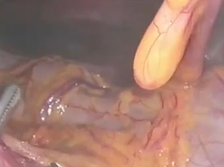Laparoscopic Right Hemicolectomy (Complete Mesocolic Excision): Uncinate First Approach Laparoscopic Right Hemicolectomy (Complete Mesocolic Excision): Uncinate First Approach
