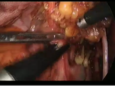 Laparoscopic Salvage Lateral Pelvic Lymph Node Dissection for Locally Recurrent Rectal Cancer Laparoscopic Salvage Lateral Pelvic Lymph Node Dissection for Locally Recurrent Rectal Cancer