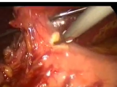 Laparoscopic Segment III Liver Resection for Isolated Colorectal Metastasis Laparoscopic Segment III Liver Resection for Isolated Colorectal Metastasis