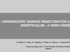 LAPAROSCOPIC SIGMOID RESECTION FOR A GIANT COLONIC DIVERTICULUM A VIDEO VIGNETTE LAPAROSCOPIC SIGMOID RESECTION FOR A GIANT COLONIC DIVERTICULUM A VIDEO VIGNETTE
