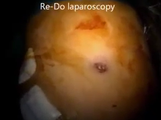 Laparoscopic Source Control for Large Pelvic Abscess after Perforated Appendicitis Laparoscopic Source Control for Large Pelvic Abscess after Perforated Appendicitis