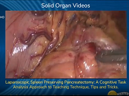 Laparoscopic Spleen Preserving Pancreatectomy