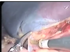 Laparoscopic Splenectomy In B-Thalassemia Major Patient