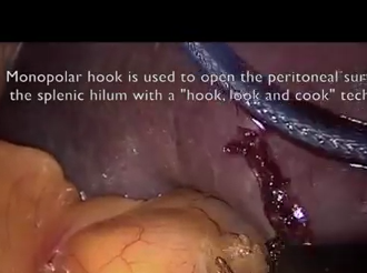 Laparoscopic Splenectomy with Selective Intra-corporeal HIlar Ligation for High Grade Splenic Injury