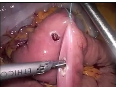 Laparoscopic Subtotal Gastrectomy With Roux-En-Y Reconstruction