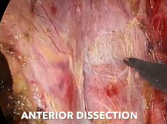 Laparoscopic supralevator posterior exenteration in a case of previous ovarian transposition Laparoscopic supralevator posterior exenteration in a case of previous ovarian transposition