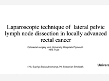 Laparoscopic technique of lateral pelvic lymph node dissection in Advanced Rectal Cancer Laparoscopic technique of lateral pelvic lymph node dissection in Advanced Rectal Cancer