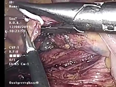 Laparoscopic Total Mesorectal Excision for Rectal Cancer