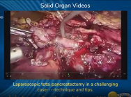 Laparoscopic total pancreatectomy in a challenging case----technique and tips