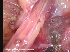 Laparoscopic Total Pelvic Exenteration for Locally Advanced Ca Rectum