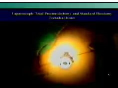 Laparoscopic total proctocolectomy and standard ileostomy Laparoscopic total proctocolectomy and standard ileostomy